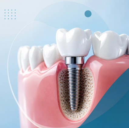 Dental Implants